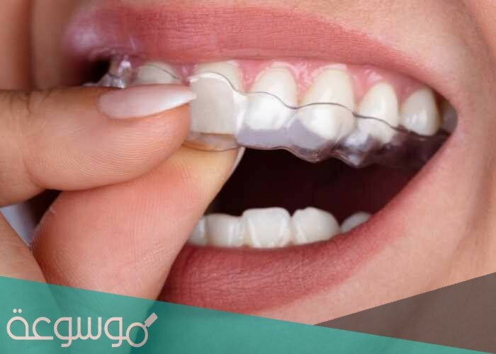 ماذا تسمى عمليه كسر السن